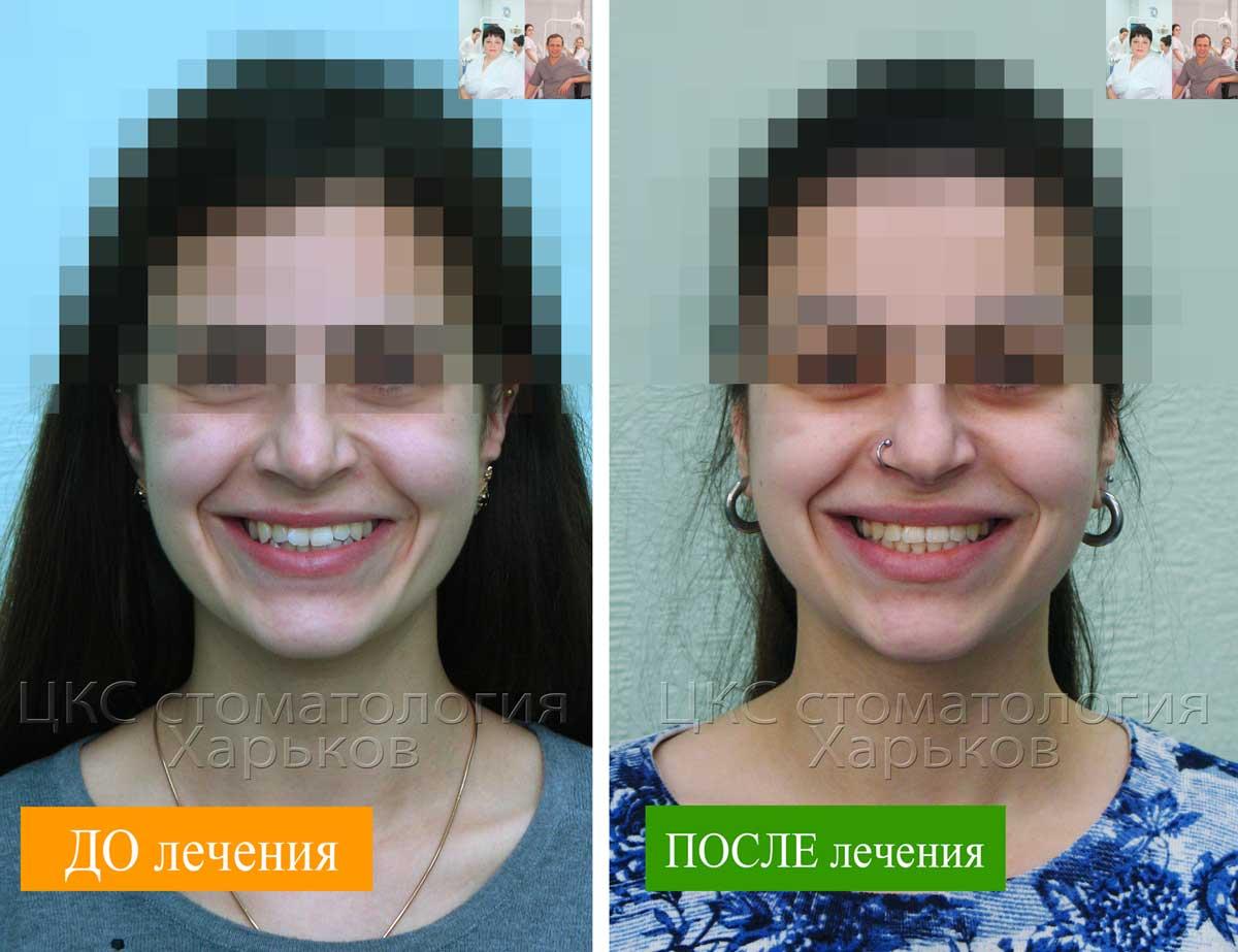 Стоматологическое лечение брекетами в Харькове