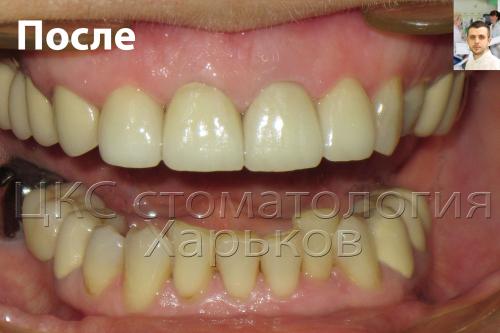 Улыбка пациентки после установки зубных коронок