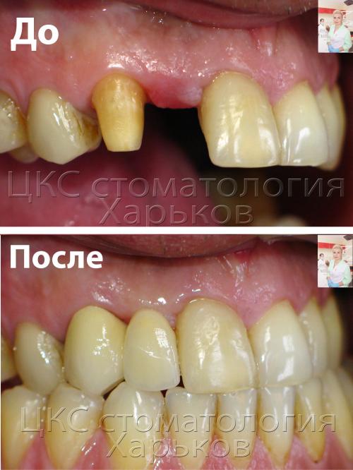 Фотография до и после установки моста пациенту