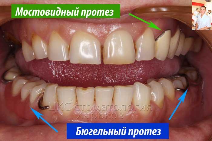 Ортопедические конструкции в стоматологии