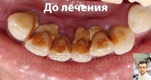 На зубах камни, десна воспалена
