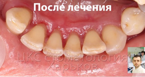 Фото после удаления зубных отложений