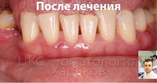 Чистка зубов – главный этап лечения пароднтита