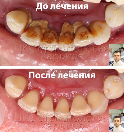 ДО и ПОСЛЕ чистки зубов