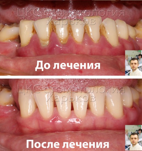 ДО и ПОСЛЕ лечения пародонтита