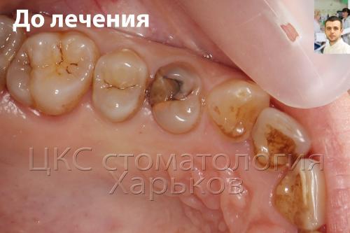 Рецидив кариеса