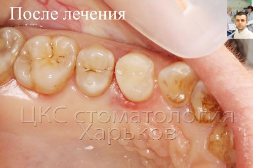 ПОСЛЕ пломбировки