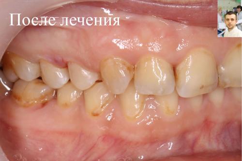 Зуб ПОСЛЕ лечения