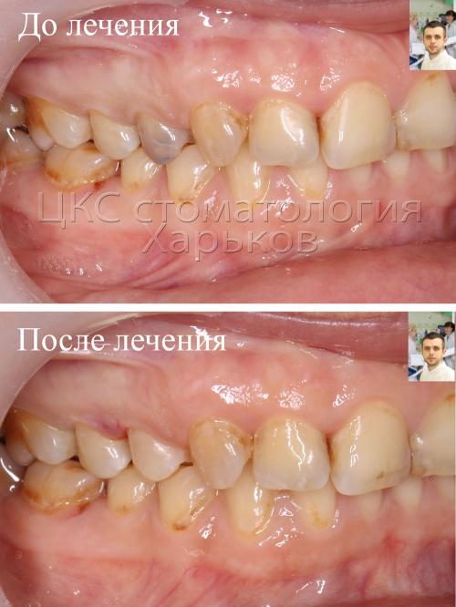 ДО и ПОСЛЕ лечения кариеса стоматология Харьков