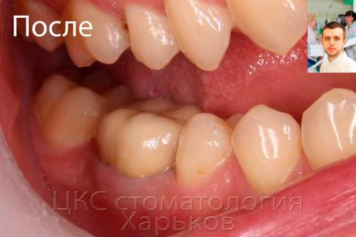 Зуб после лечения каналов и изготовления коронки