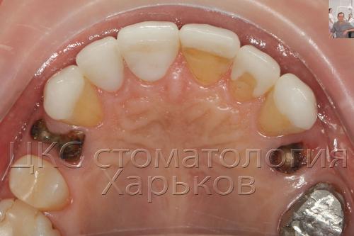 Иллюстрация чем отличается коронки от виниров Отличие коронки от винира