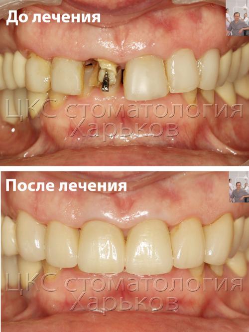 2017_03_08_до_после