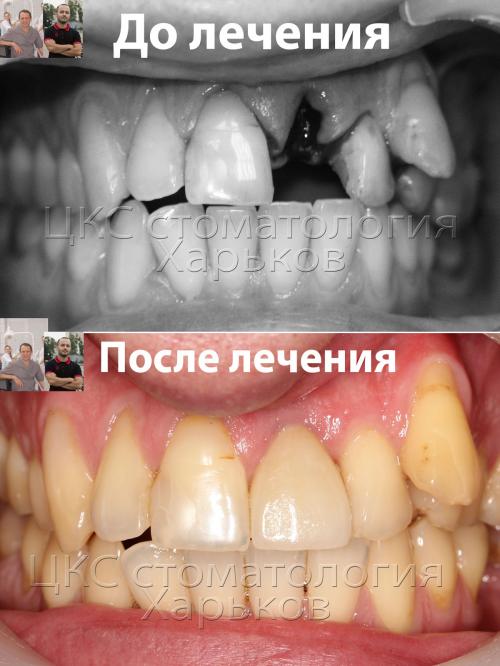 На поверхность абатмента фиксирована коронка из безметаловой керамики Результаты имплантации переднего зуба
