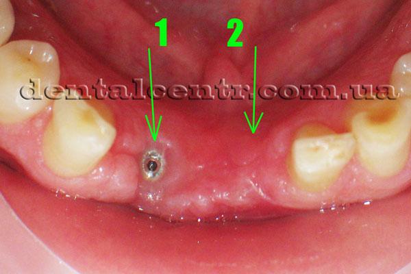 Дефект десны над крышкой-заглушкой