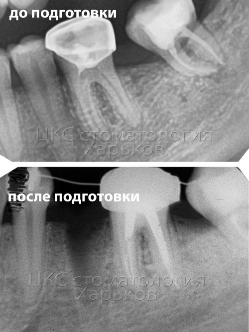 Зуб до и после подготовки к ортодонтическому лечению