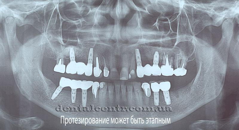 Поэтапная имплантация зубов Панорамная рентгенограмма многоэтапной имплантации зубов