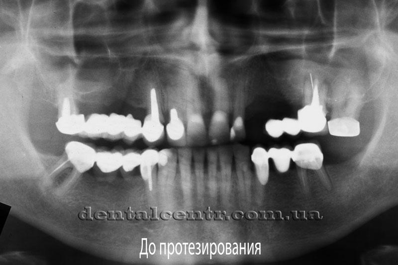 Панорамный снимок пациента до проведения протезирования на зубной имплантации Панорамный снимок пациента до проведения протезирования
