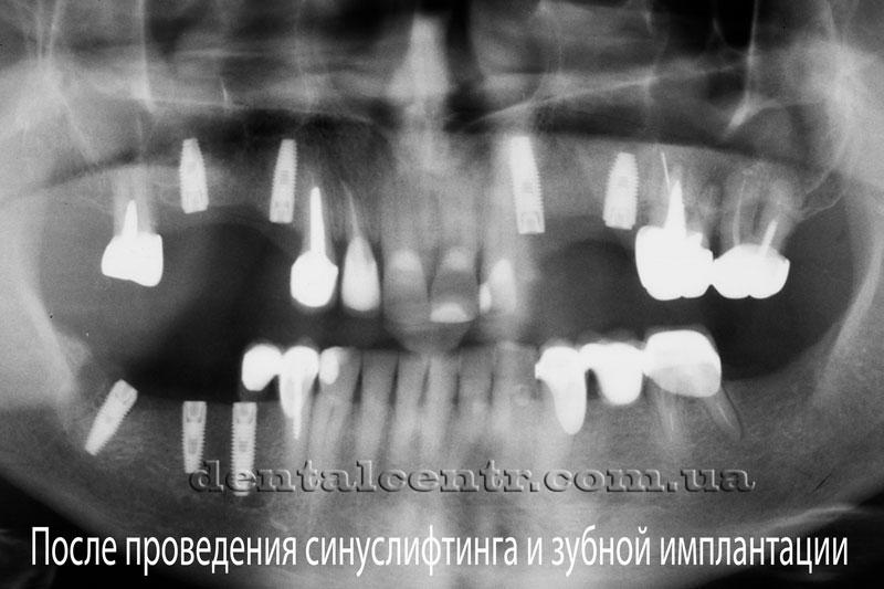 Панорамный снимок пациента после установки зубных имплантатов Панорамный снимок после установки зубных имплантатов
