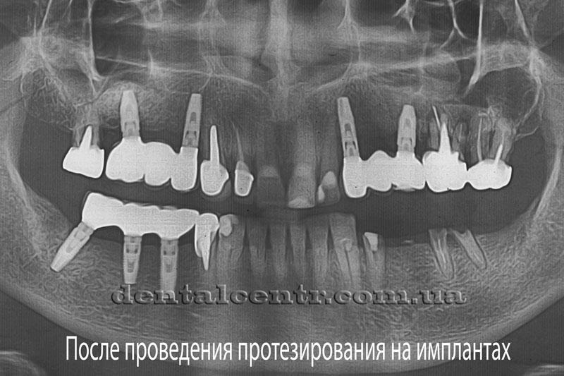 После проведения протезирования на зубных имплантах Панорамный снимок после проведения протезирования на зубных имплантах