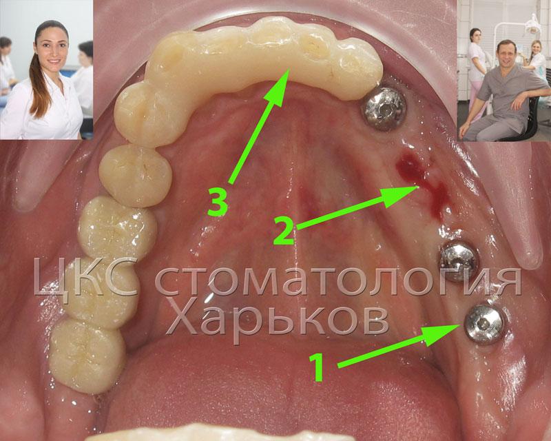 зубная имплантация плюс шинирование