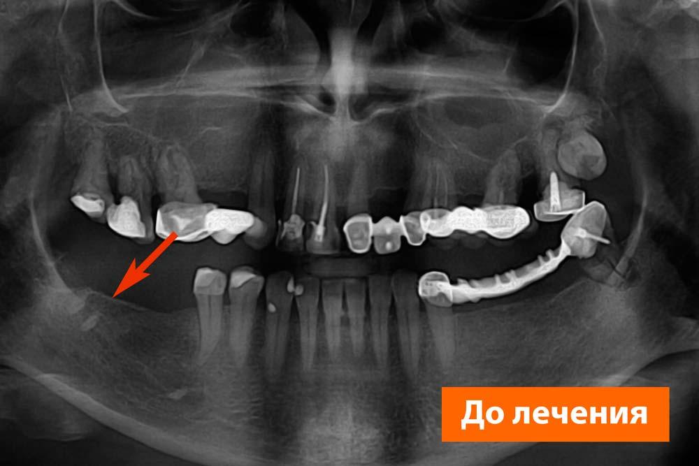 обломки корней