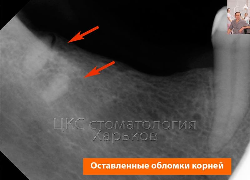 Обломки корней прицельный снимок