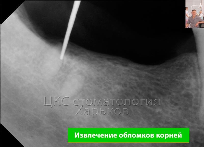 Извлечение корней прицельный снимок