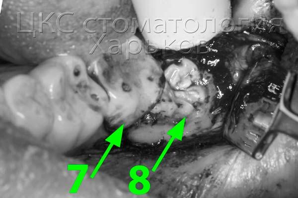 04 расположение второго и третьего моляров