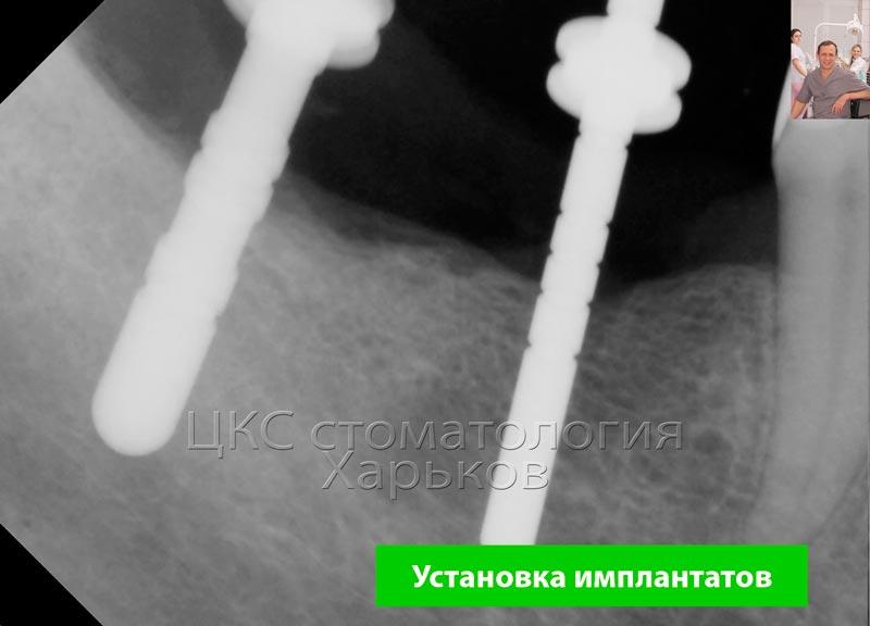 Установка зубных имплантов