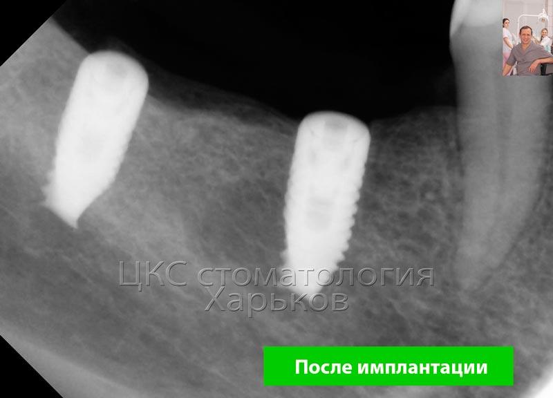 После зубной имплантации