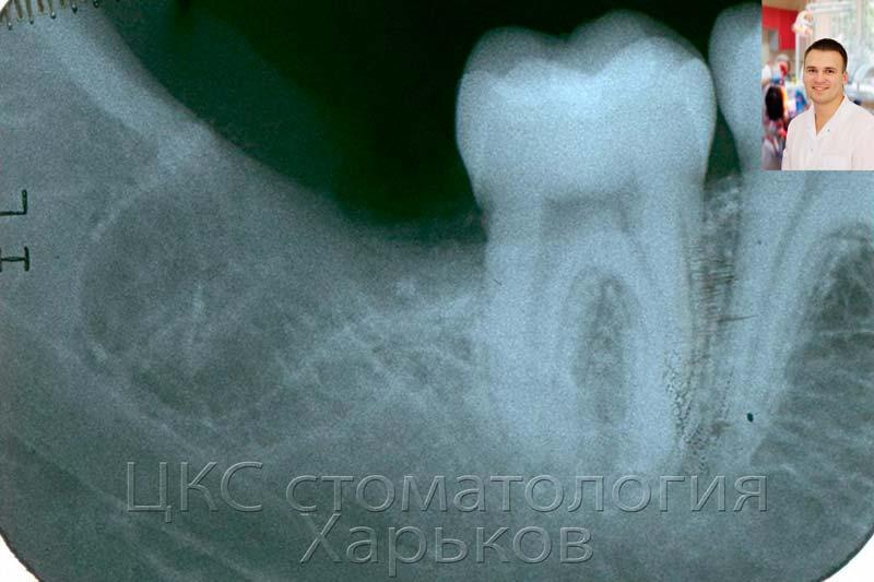 уменьшение травмирования раны в ходе операции