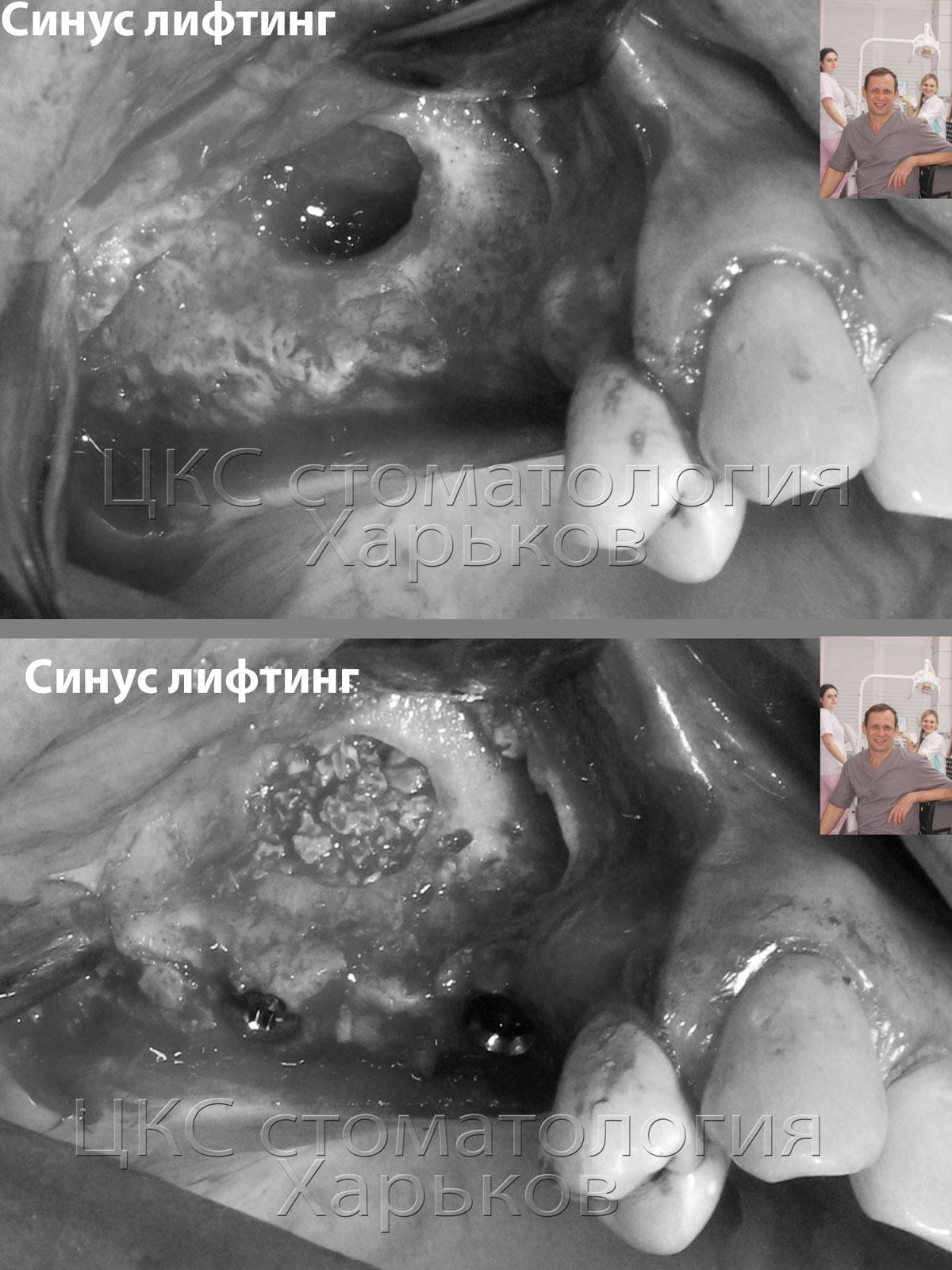 Синус-лифтинг в три этапа Синус-лифтинг. Фото в ходе операции