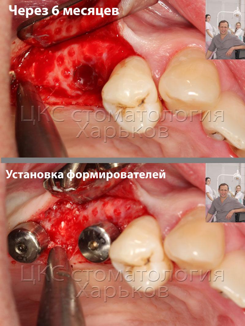 Удаление титановой сетки и микровинтов после установка формирователей Увеличение объема кости альвеолярного отростка после операции