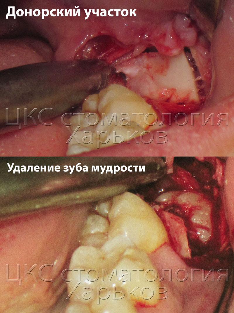 Удаление ретинированной восьмерки (зуба мудрости) Удаление ретинированной восьмерки фото
