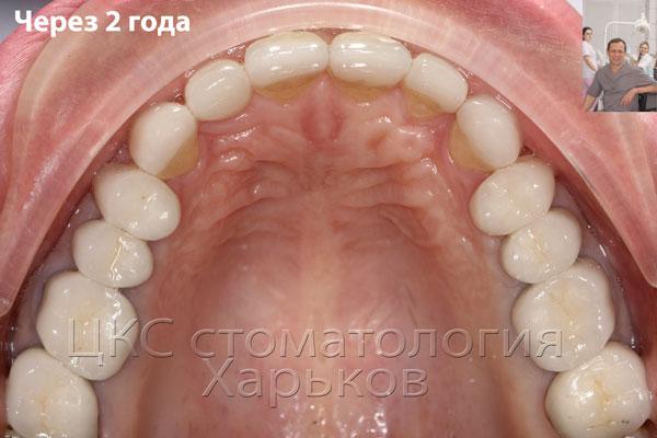 фото окклюзионной поверхности зубов