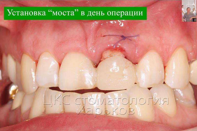 Временный зуб установлен в день операции