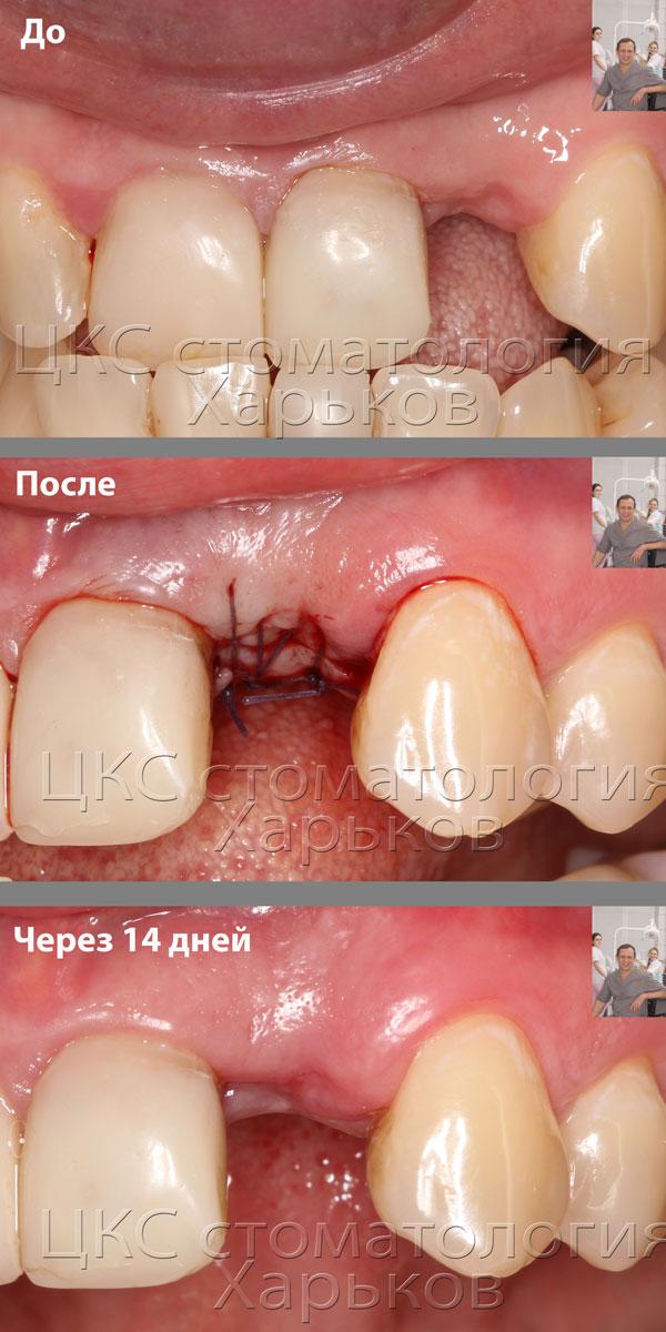 установка тела зубного имплантата