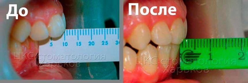 брекеты-устраняют-сагитальную-щель