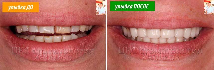 голливудские-виниры