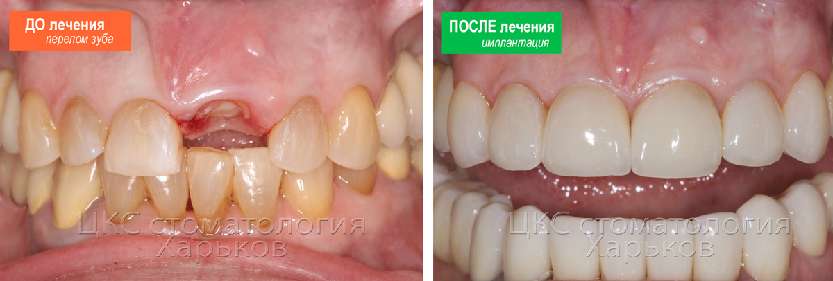 до-и-после-имплантации-фронтального-зуба
