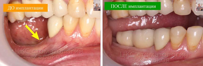 до-и-после-импланты-зубные-02