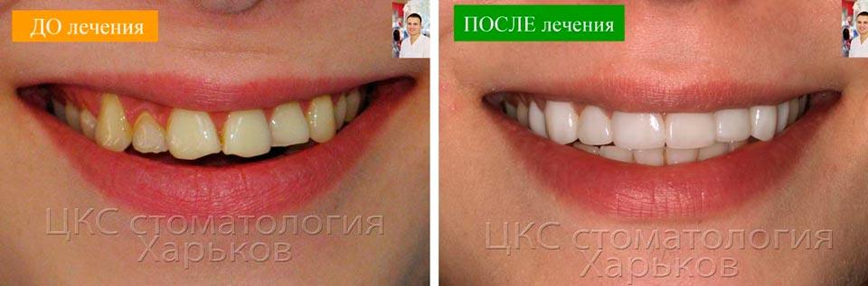 ровные-зубы-без-брекетов
