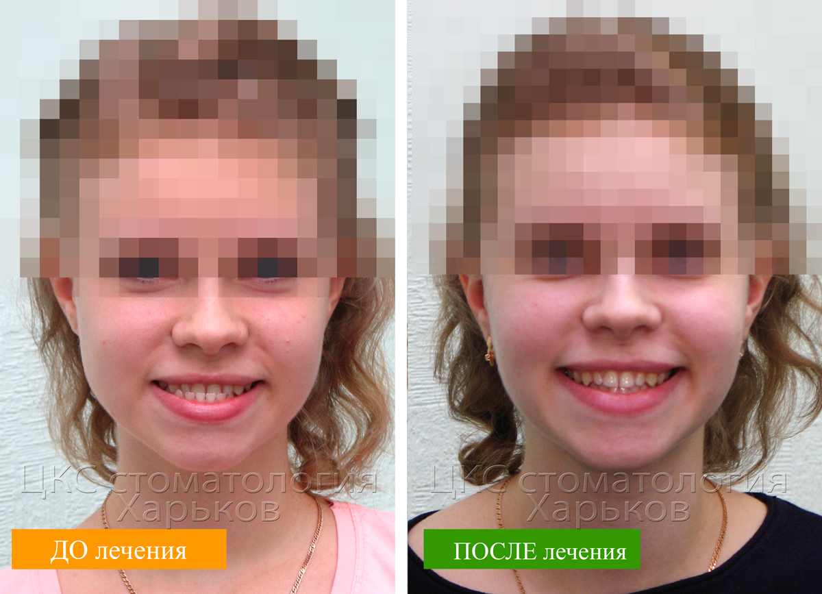 улыбка-до-и-после-брекетов