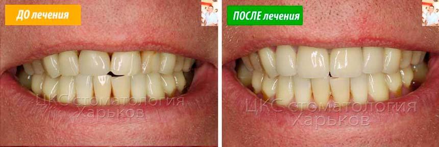 улыбка-и-виниры-до-и-после
