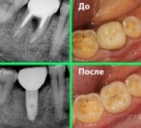 Зубная имплантация без хирургических разрезов, Стоматология Харьков