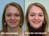 Исправить среднюю линию. Брекеты в Харькове
