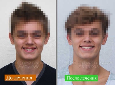 Лечение брекетами без удаления зубов, современное лечение в Харькове