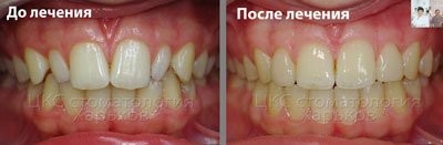 Лечение брекетами зубов шиповидной формы
