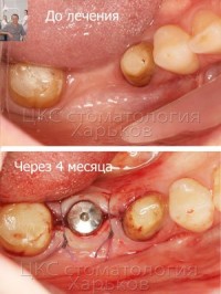Наращивание костной ткани для имплантации зубов