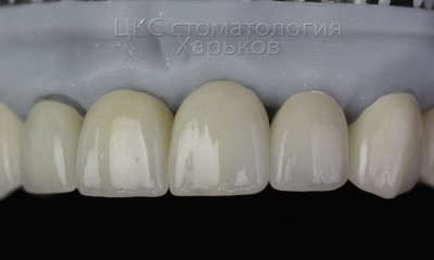 Патологическая стираемость зубов. Вернуть красоту улыбке